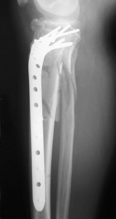Tibia, Shaft:  Synthes Tibial L.I.S.S. (Implant 251)